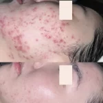 How Do You Treat Persistent Breakouts Or Congestion?
