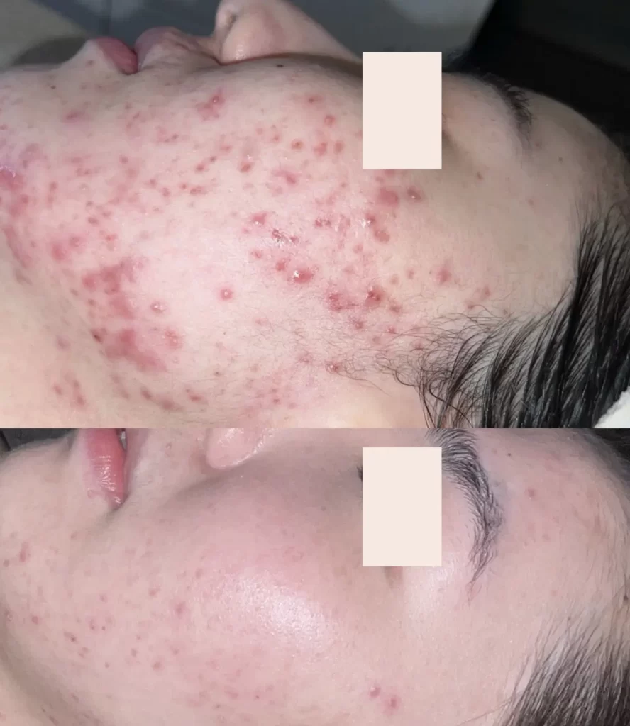 How Do You Treat Persistent Breakouts Or Congestion?