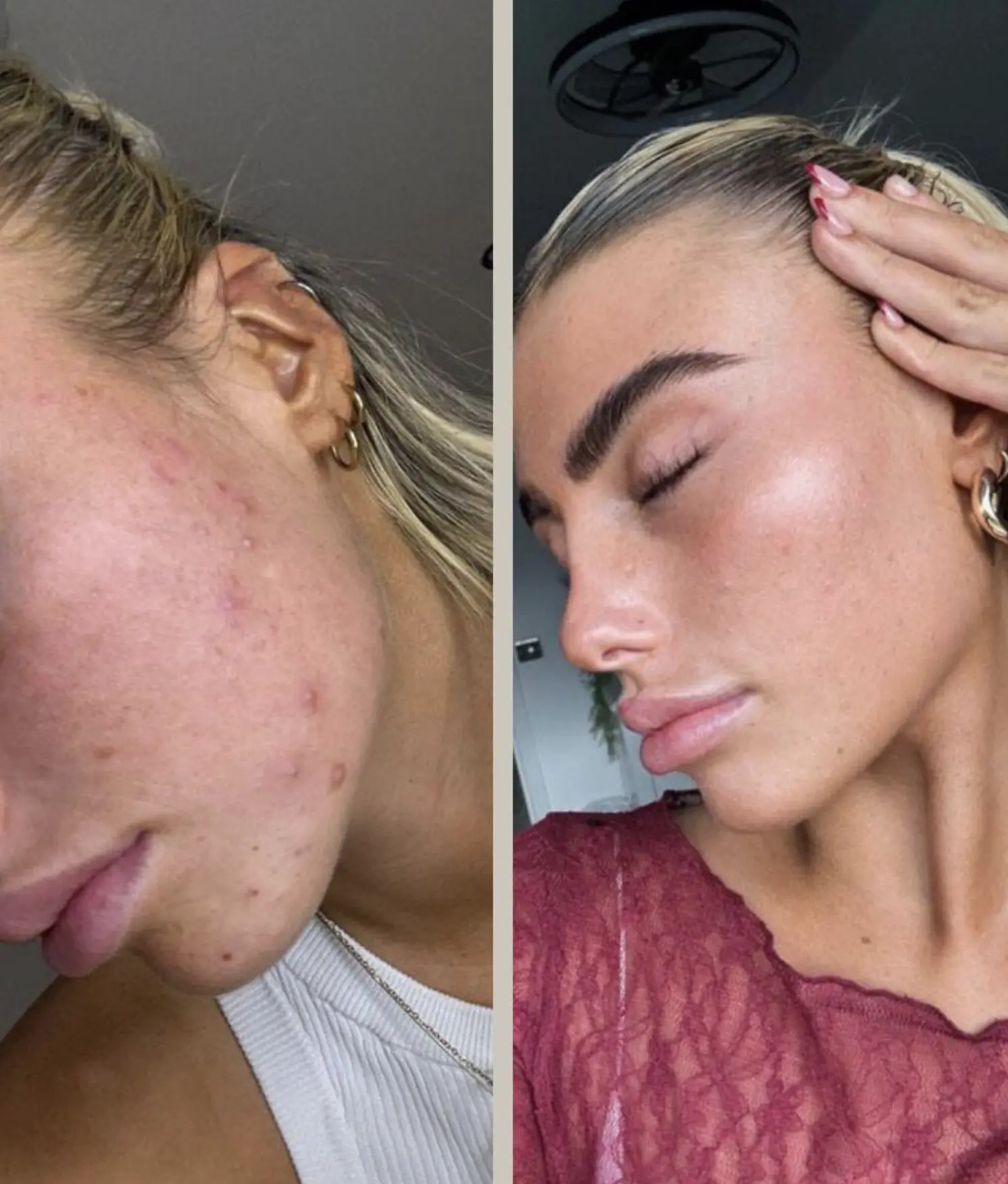 how to treat persistent breakouts