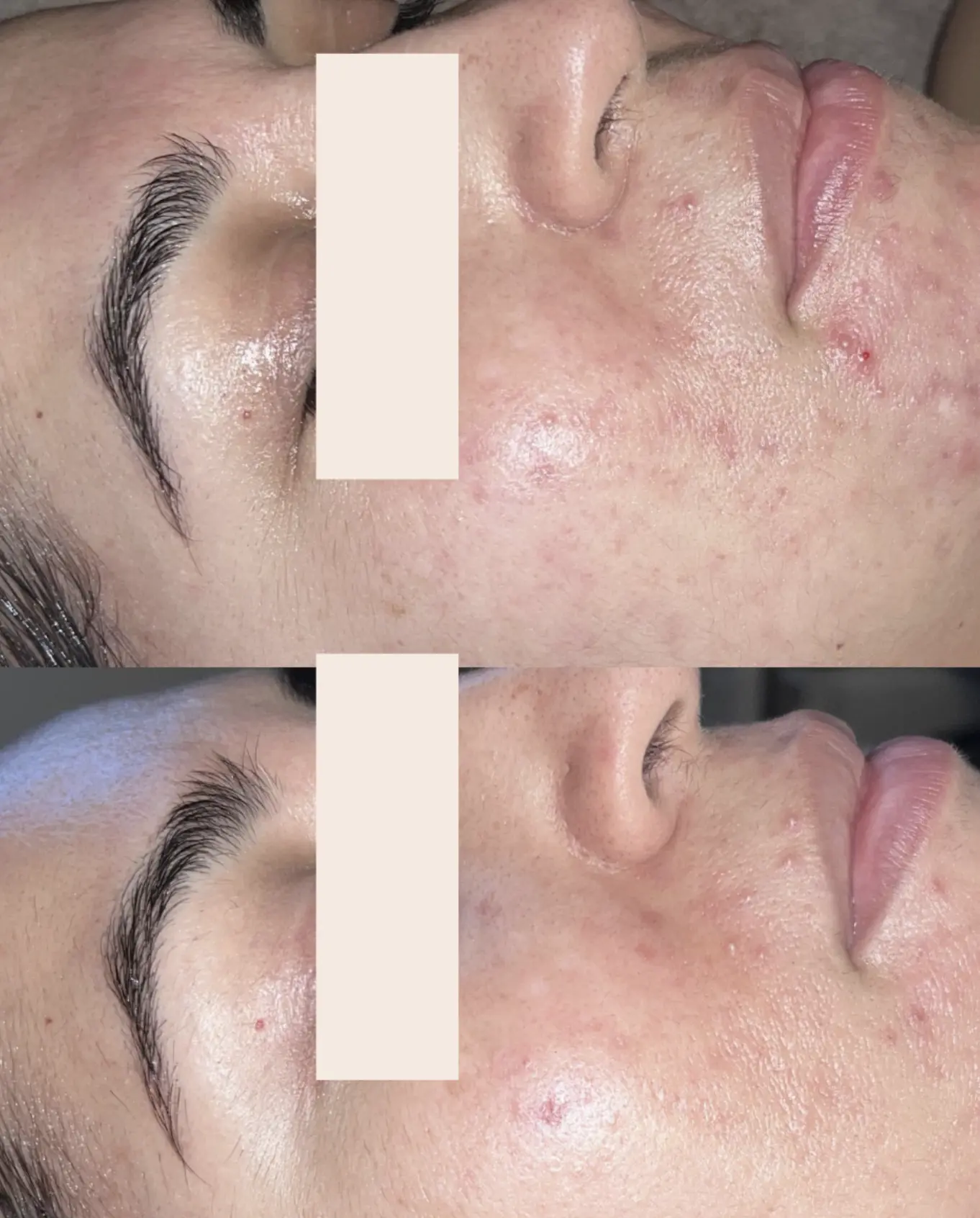 how to unclog pores naturally