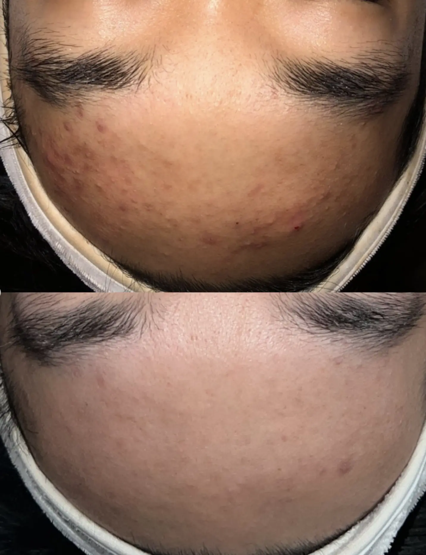skincare routine for acne prone skin
