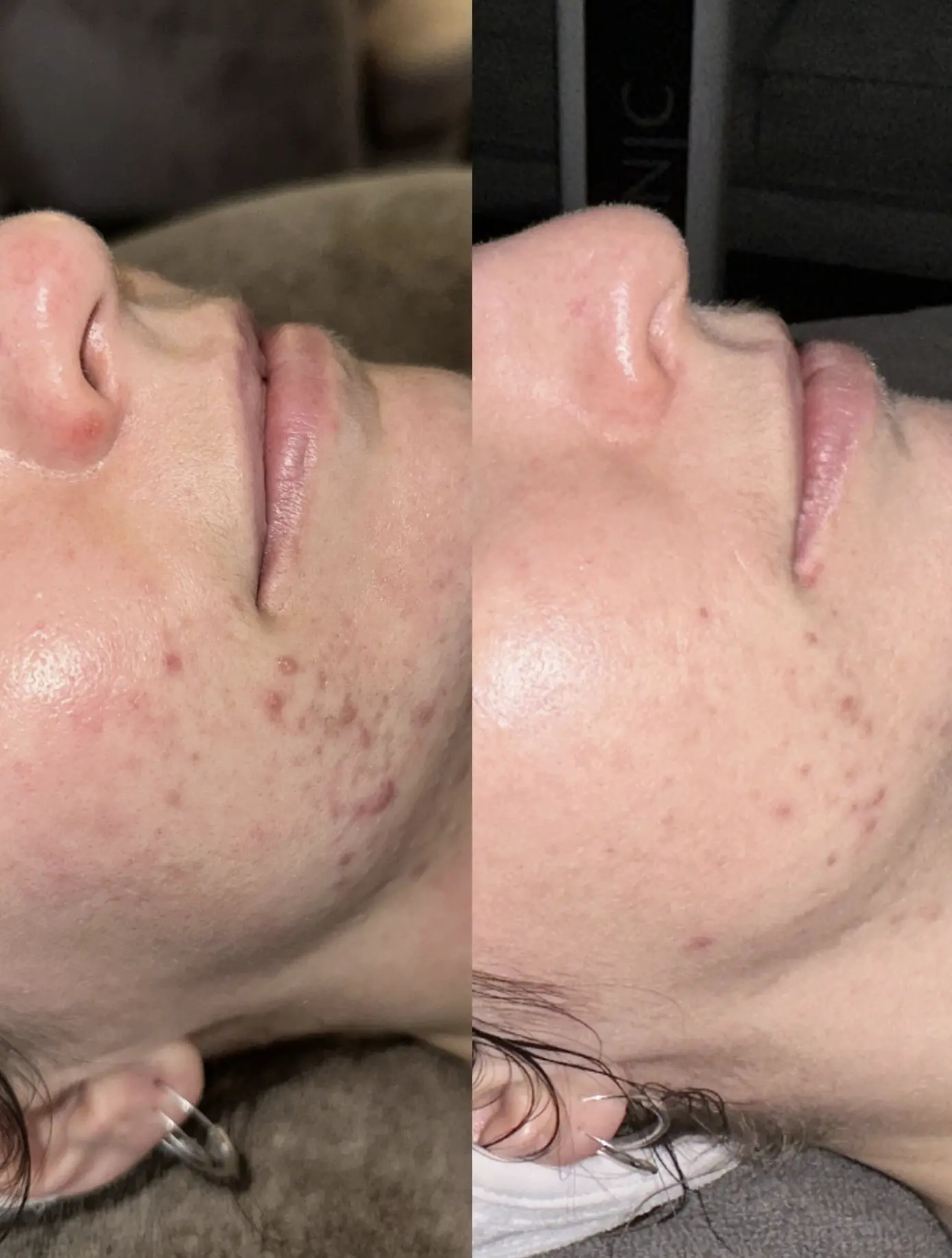 what causes clogged pores and acne